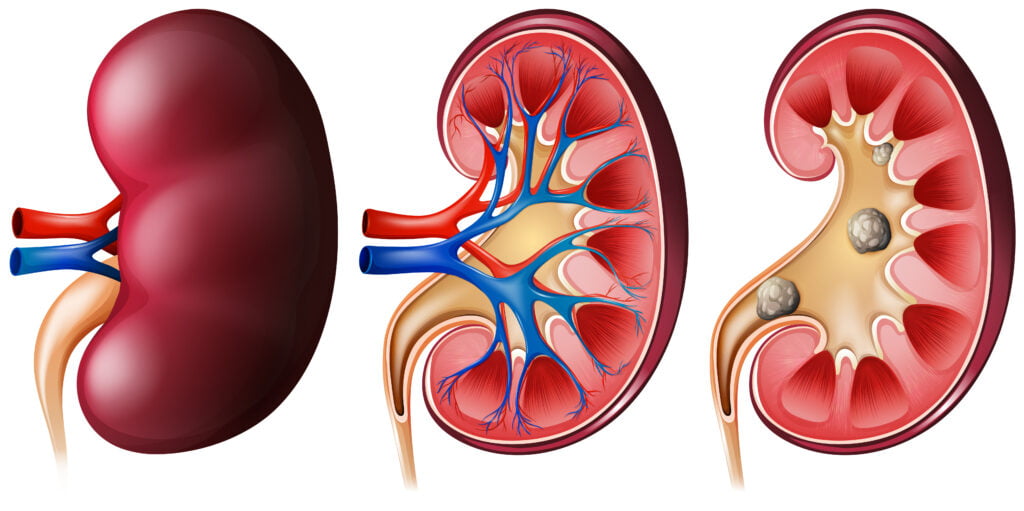 Kidney stone stent, causes, symptoms, meditation and doctor