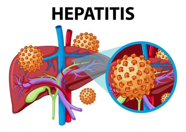 Hepatitis A vaccine, causes, symptoms and Treatment